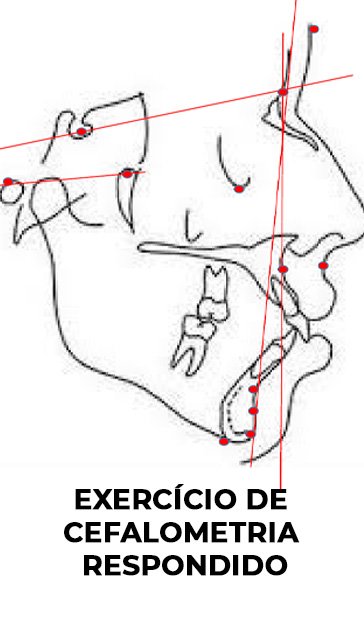 Exercício de Cefalometria respondido